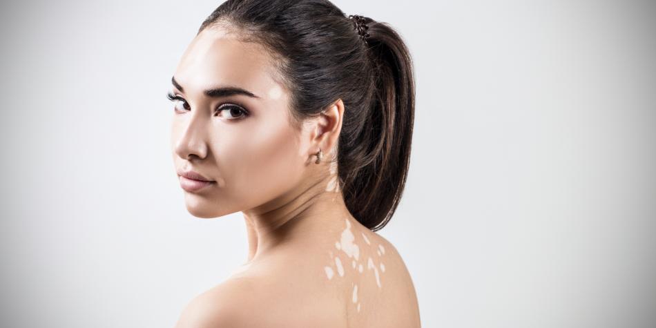 Vitiligo treatment